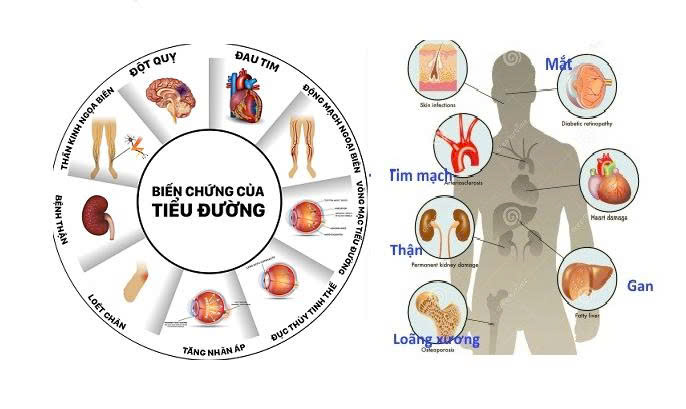 Các biến chứng của bệnh đái tháo đường thường gặp